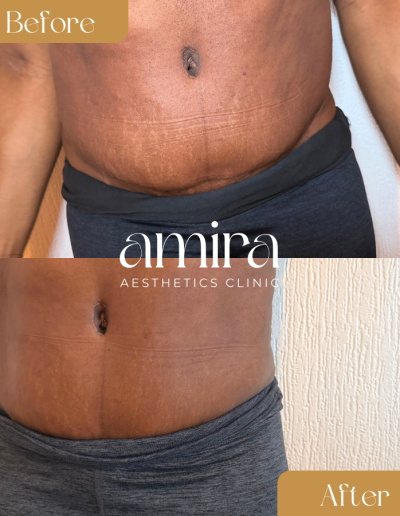Amira Aesthetics Clinic Before And After Fat Dissolving