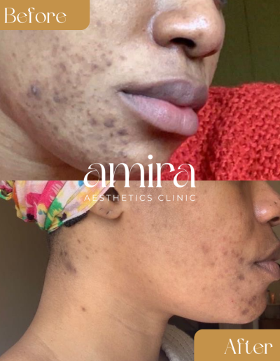 Amira Aesthetics Clinic Before And After Microneedling