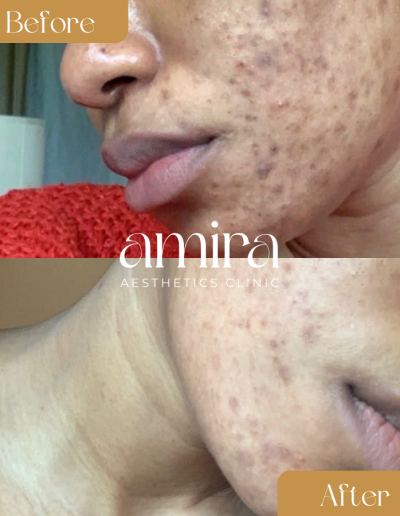 Amira Aesthetics Clinic Before And After Microneedling