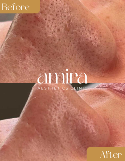 Amira Aesthetics Clinic Before And After Advanced Facial