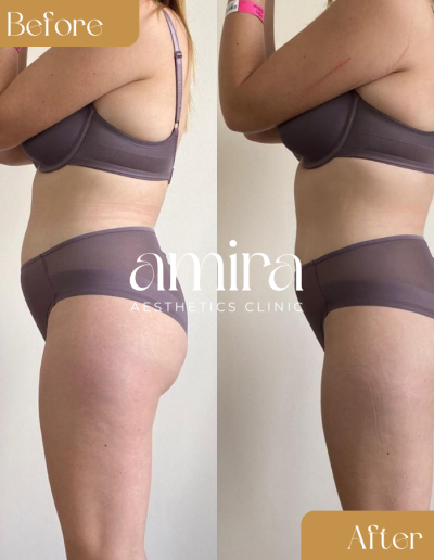 Amira Aesthetics Clinic Before And After Pressotherapy